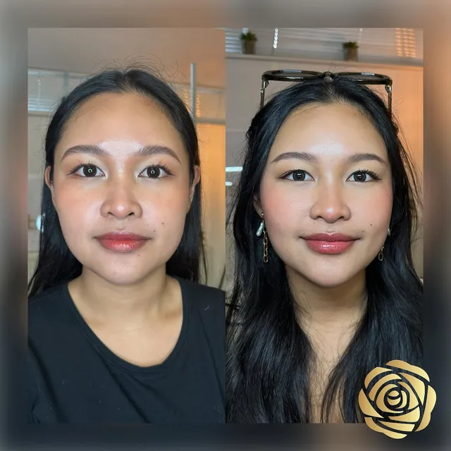 Before and after jawline slimming with anti-wrinkle injections, softening a strong jaw into a gentle V-shape