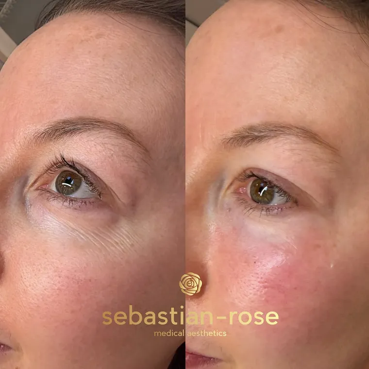 Before and after a subtle under-eye treatment with Juvelook