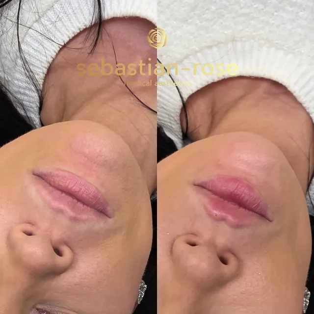 Before and after natural lip filler with subtle shape and definition