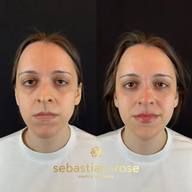 Before and after a subtle full-face refresh with dermal filler