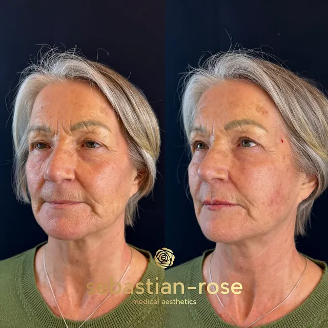 Before and after full-face rejuvenation on a mature patient